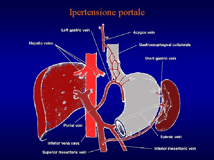 Ipertensione portale 