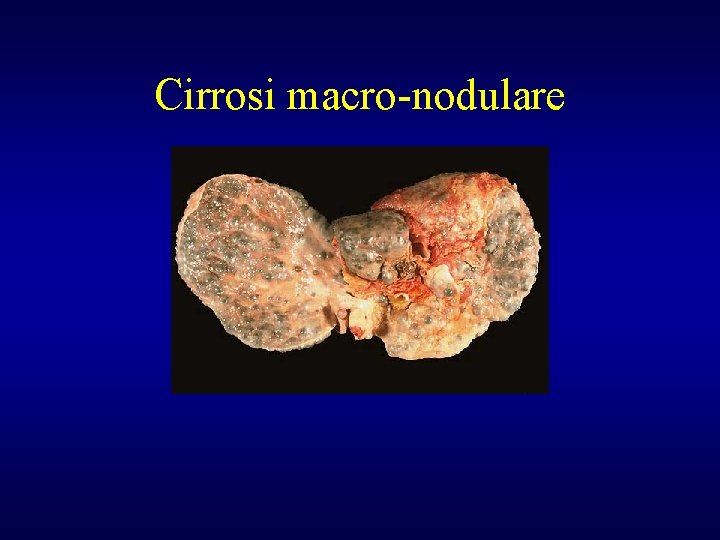 Cirrosi macro-nodulare 