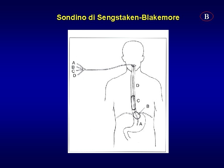 Sondino di Sengstaken-Blakemore B 