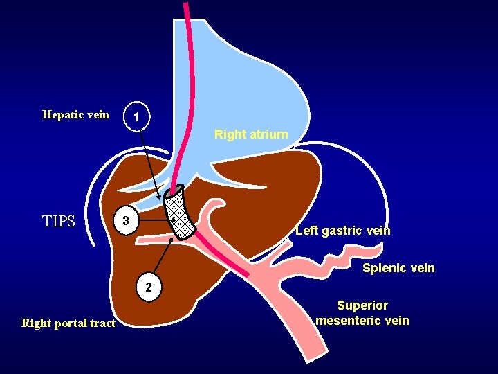 Hepatic vein 1 Right atrium TIPS 3 Left gastric vein Splenic vein 2 Right