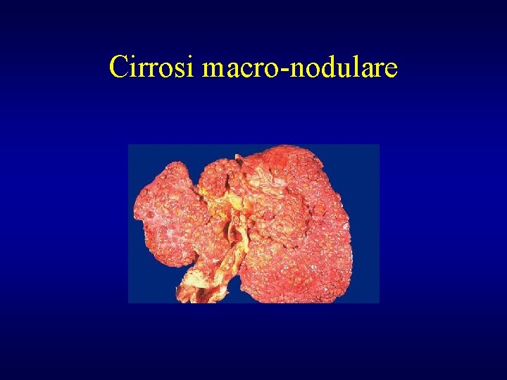 Cirrosi macro-nodulare 