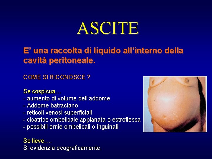 ASCITE E’ una raccolta di liquido all’interno della cavità peritoneale COME SI RICONOSCE ?