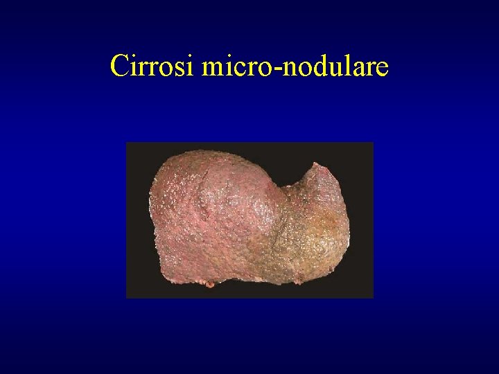 Cirrosi micro-nodulare 