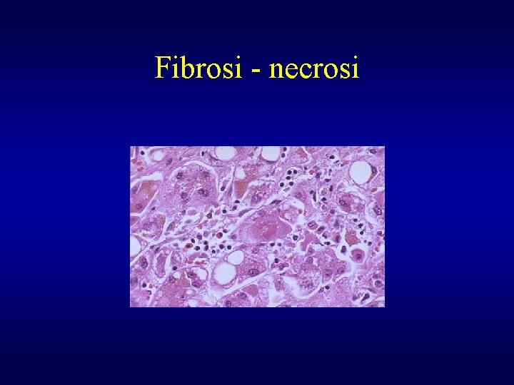 Fibrosi - necrosi 