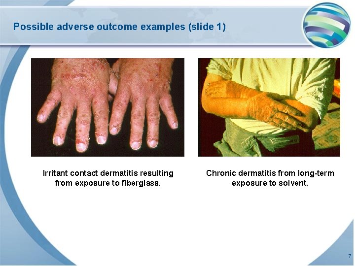 Possible adverse outcome examples (slide 1) Irritant contact dermatitis resulting from exposure to fiberglass.