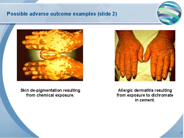 Possible adverse outcome examples (slide 2) Skin de-pigmentation resulting from chemical exposure. Allergic dermatitis
