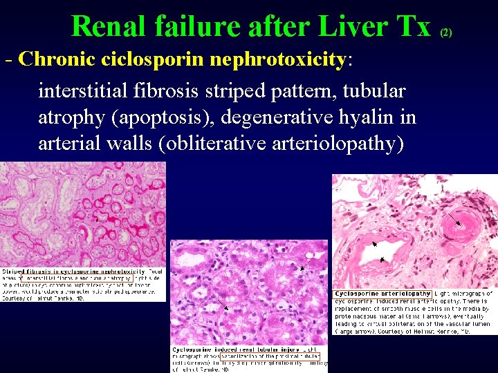Renal failure after Liver Tx - Chronic ciclosporin nephrotoxicity: interstitial fibrosis striped pattern, tubular