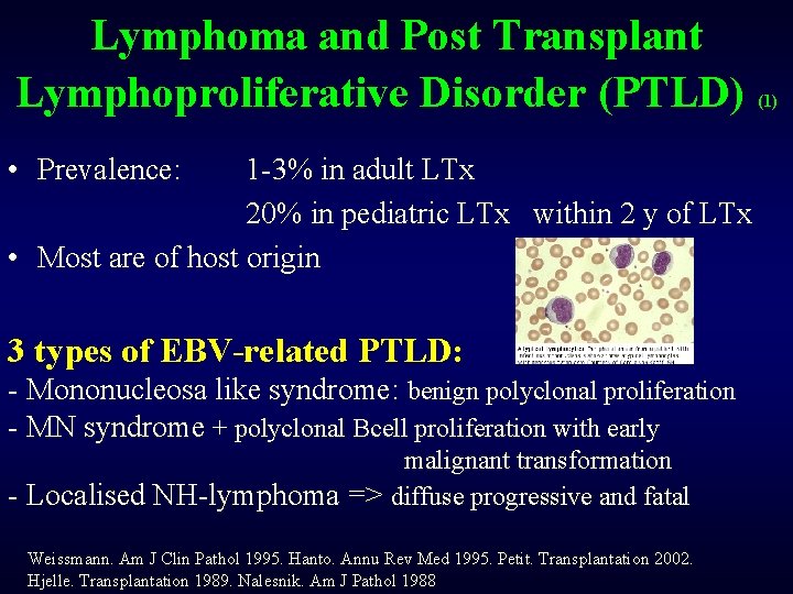 Lymphoma and Post Transplant Lymphoproliferative Disorder (PTLD) • Prevalence: 1 -3% in adult LTx