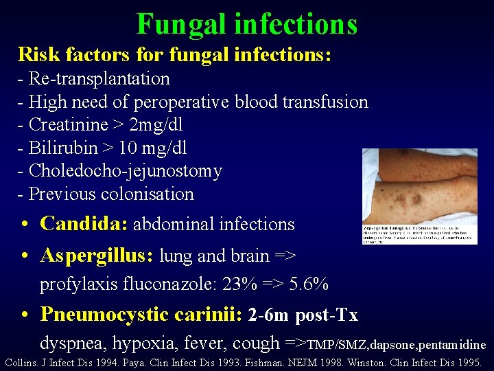 Fungal infections Risk factors for fungal infections: - Re-transplantation - High need of peroperative