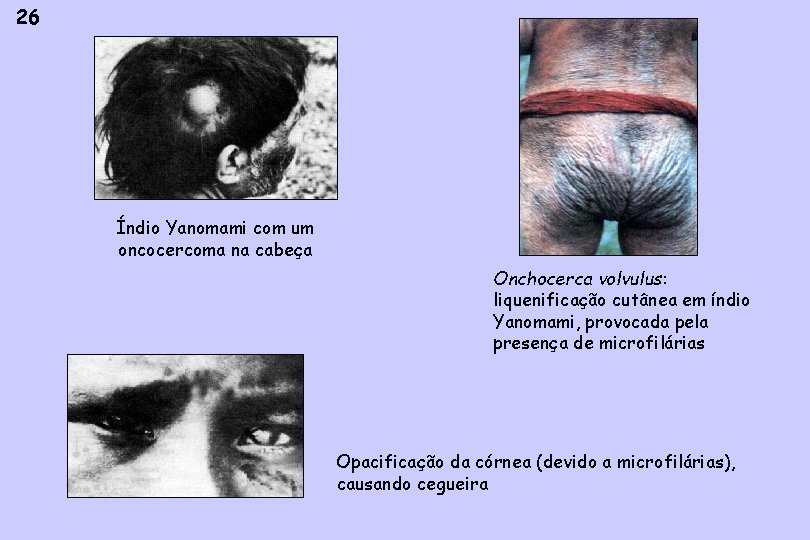 26 Índio Yanomami com um oncocercoma na cabeça Onchocerca volvulus: liquenificação cutânea em índio