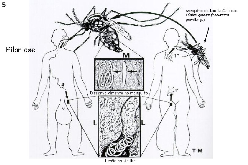 5 Mosquitos da família Culicidae (Culex quinquefasciatus = pernilongo) Filariose Desenvolvimento no mosquito Lesão