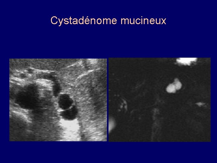 Cystadénome mucineux 