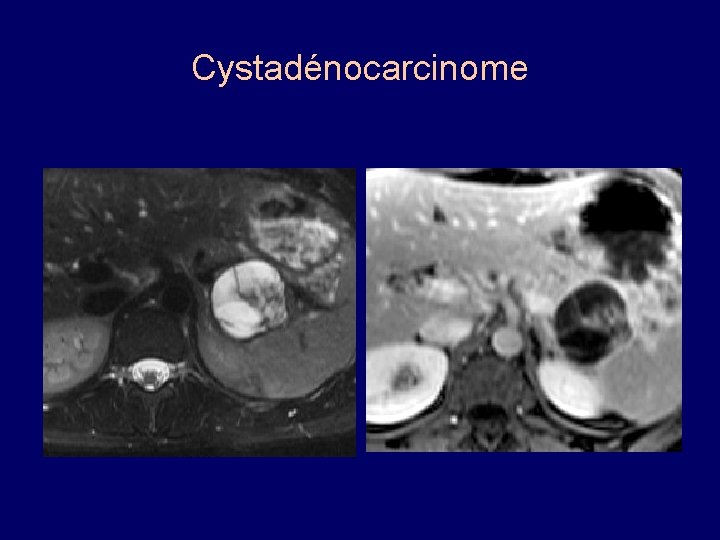 Cystadénocarcinome 