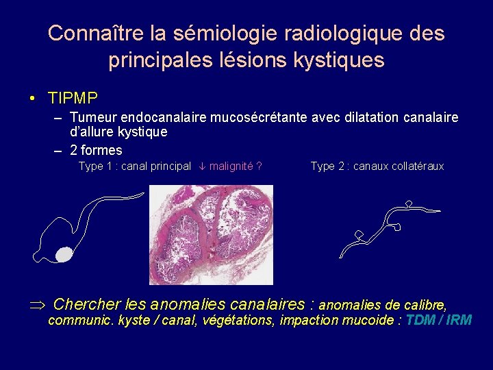 Connaître la sémiologie radiologique des principales lésions kystiques • TIPMP – Tumeur endocanalaire mucosécrétante