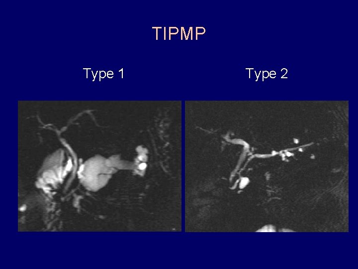 TIPMP Type 1 Type 2 
