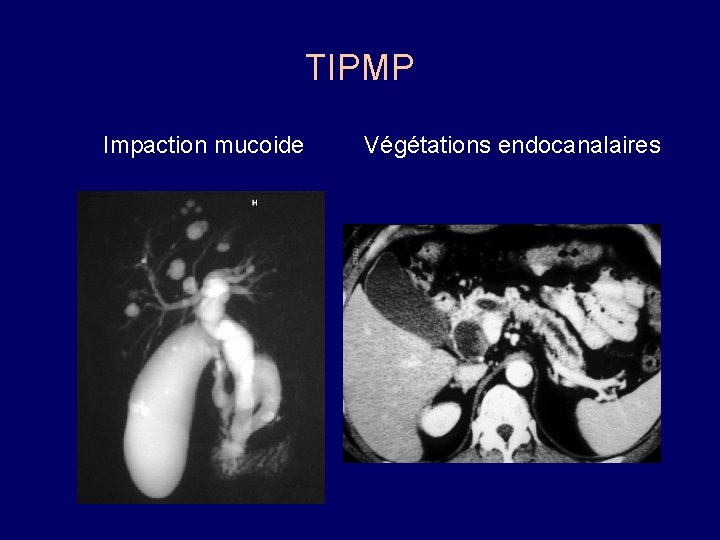 TIPMP Impaction mucoide Végétations endocanalaires 