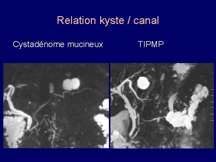 Relation kyste / canal Cystadénome mucineux TIPMP 