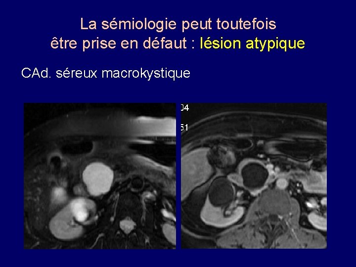 La sémiologie peut toutefois être prise en défaut : lésion atypique CAd. séreux macrokystique
