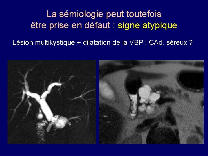 La sémiologie peut toutefois être prise en défaut : signe atypique Lésion multikystique +