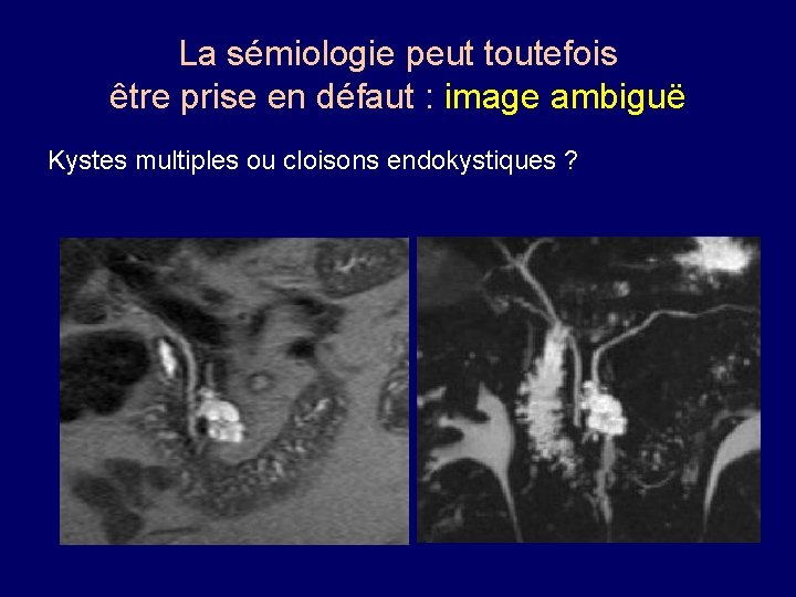 La sémiologie peut toutefois être prise en défaut : image ambiguë Kystes multiples ou