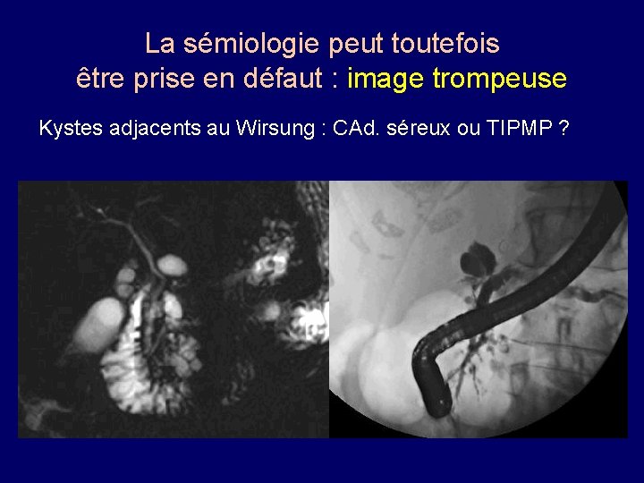 La sémiologie peut toutefois être prise en défaut : image trompeuse Kystes adjacents au