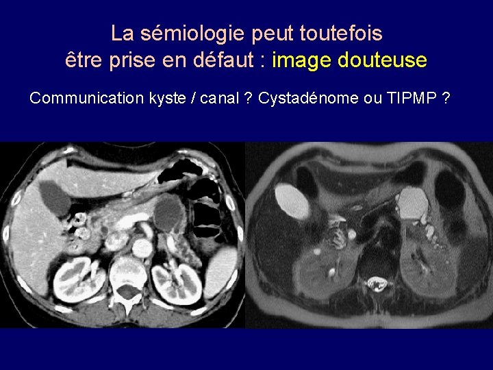 La sémiologie peut toutefois être prise en défaut : image douteuse Communication kyste /