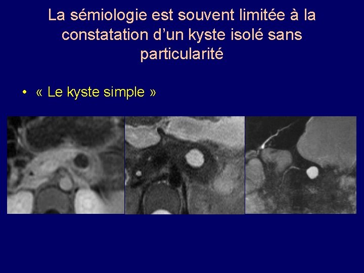 La sémiologie est souvent limitée à la constatation d’un kyste isolé sans particularité •