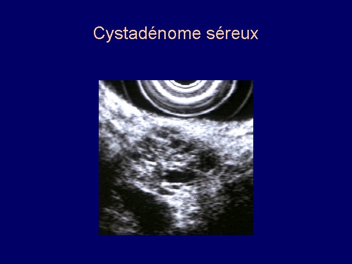 Cystadénome séreux 