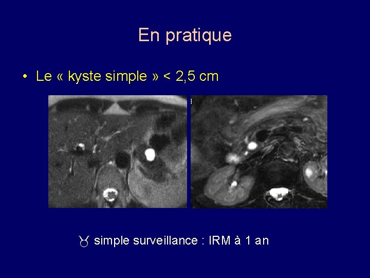 En pratique • Le « kyste simple » < 2, 5 cm simple surveillance