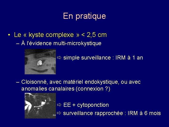 En pratique • Le « kyste complexe » < 2, 5 cm – À