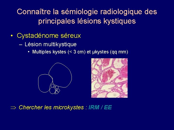 Connaître la sémiologie radiologique des principales lésions kystiques • Cystadénome séreux – Lésion multikystique