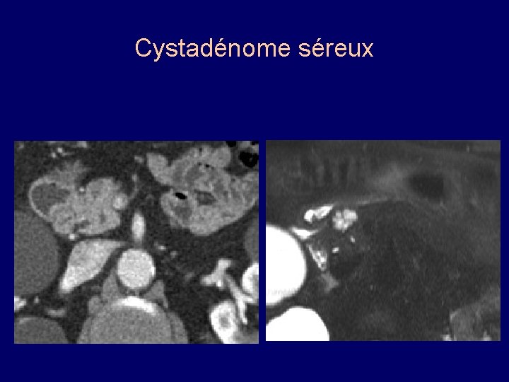Cystadénome séreux 