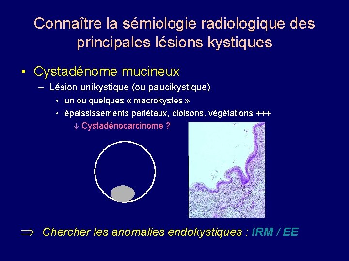 Connaître la sémiologie radiologique des principales lésions kystiques • Cystadénome mucineux – Lésion unikystique
