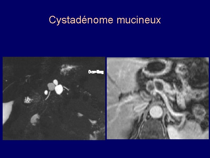 Cystadénome mucineux 
