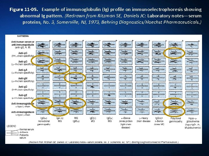 Figure 11 -05. Example of immunoglobulin (Ig) profile on immunoelectrophoresis showing abnormal Ig pattern.