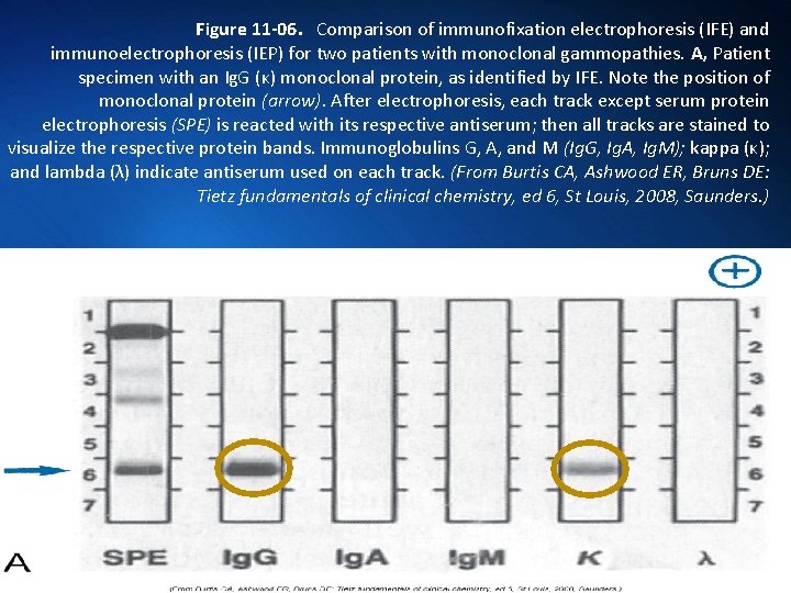 Figure 11 -06. Comparison of immunofixation electrophoresis (IFE) and immunoelectrophoresis (IEP) for two patients
