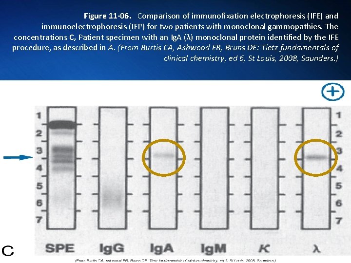 Figure 11 -06. Comparison of immunofixation electrophoresis (IFE) and immunoelectrophoresis (IEP) for two patients