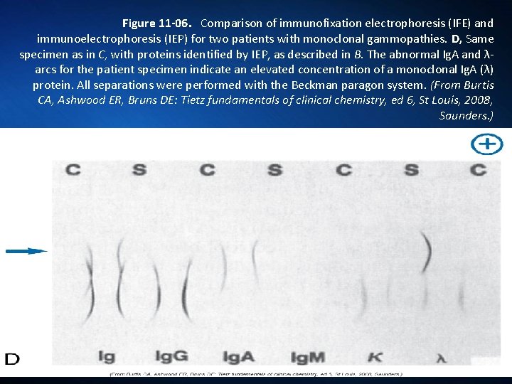 Figure 11 -06. Comparison of immunofixation electrophoresis (IFE) and immunoelectrophoresis (IEP) for two patients