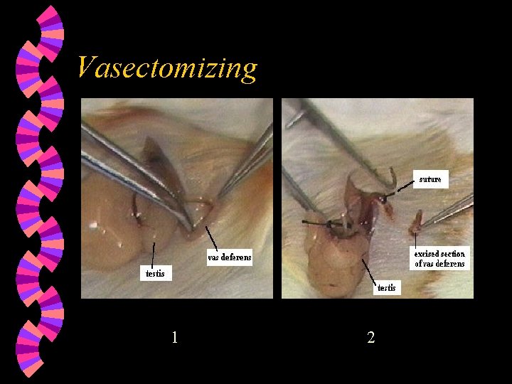 Vasectomizing 1 2 