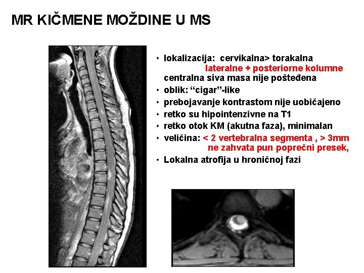 MR KIČMENE MOŽDINE U MS • lokalizacija: cervikalna> torakalna lateralne + posteriorne kolumne centralna