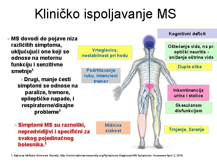 Kliničko ispoljavanje MS » MS dovodi do pojave niza različitih simptoma, Vrtoglavica, uključujući one