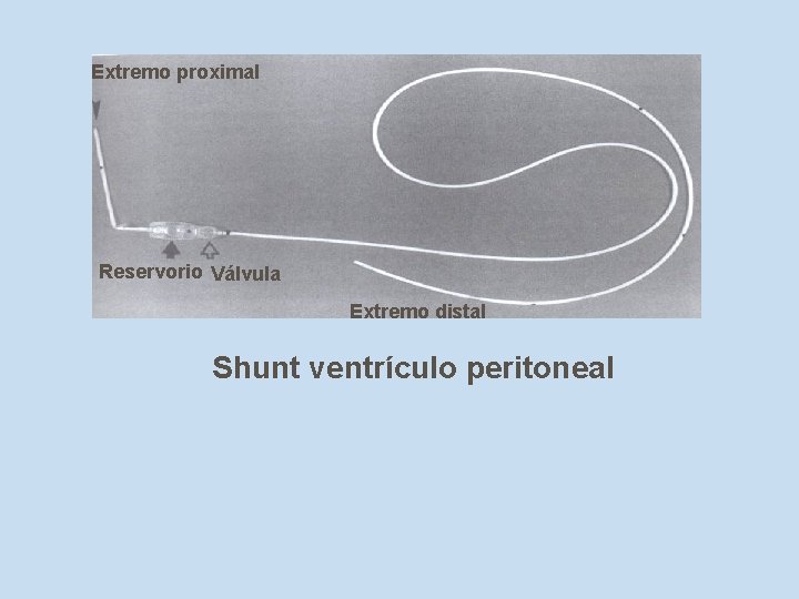 Extremo proximal Reservorio Válvula Extremo distal Shunt ventrículo peritoneal 
