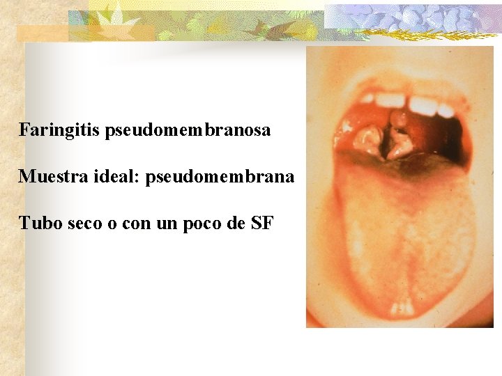 Faringitis pseudomembranosa Muestra ideal: pseudomembrana Tubo seco o con un poco de SF 