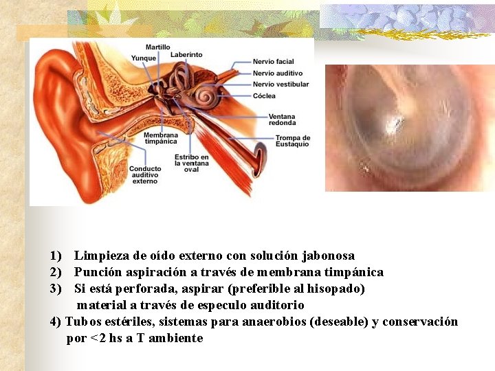 1) Limpieza de oído externo con solución jabonosa 2) Punción aspiración a través de