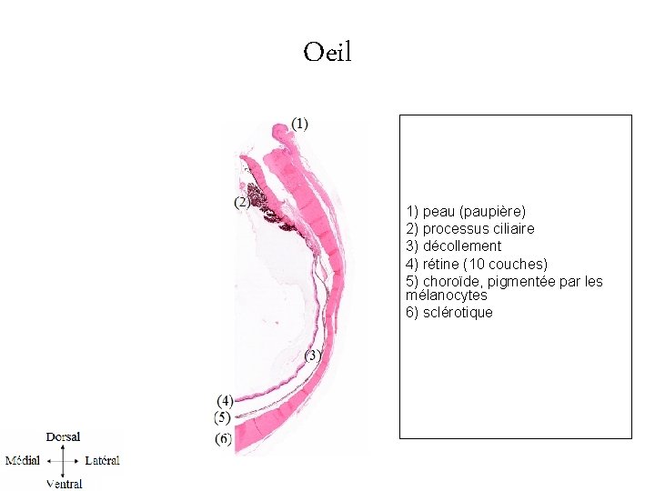 Oeil 1) peau (paupière) 2) processus ciliaire 3) décollement 4) rétine (10 couches) 5)