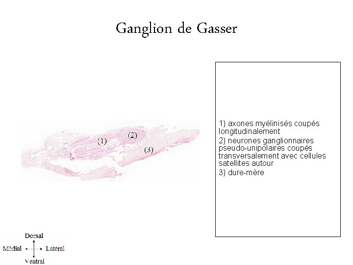 Ganglion de Gasser 1) axones myélinisés coupés longitudinalement 2) neurones ganglionnaires pseudo-unipolaires coupés transversalement