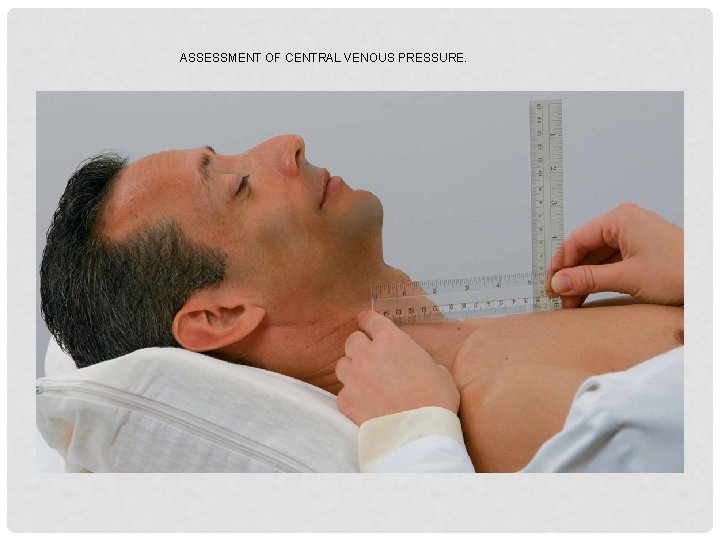 ASSESSMENT OF CENTRAL VENOUS PRESSURE. 