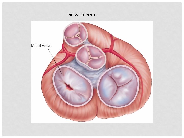 MITRAL STENOSIS. 