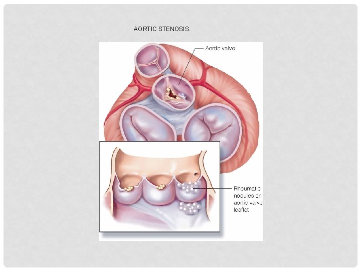 AORTIC STENOSIS. 