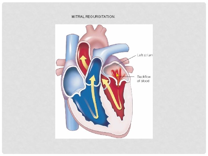 MITRAL REGURGITATION. 